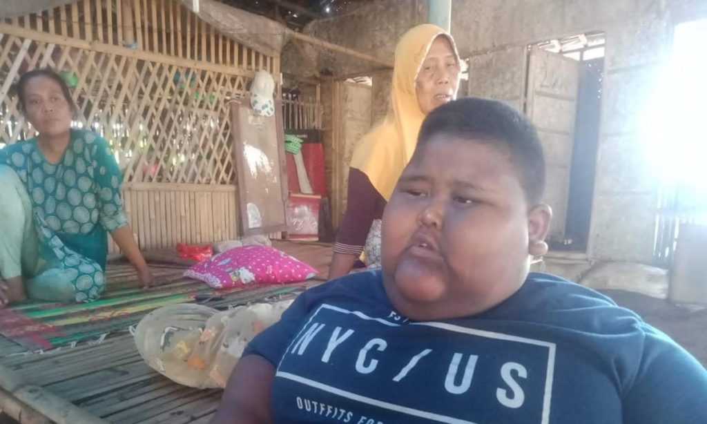 Bocah Obesitas di Karawang Mengeluh Sesak Napas Sebelum Meninggal