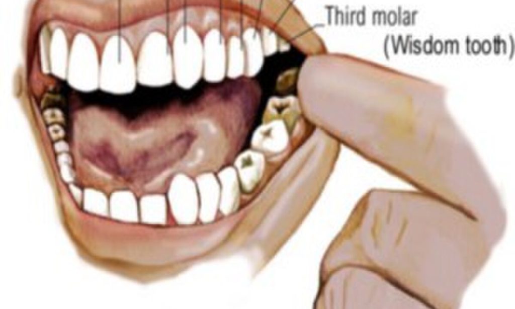 4 Penyebab Gigi Bungsu Harus Dicabut, Kenali Sebelum Terlambat