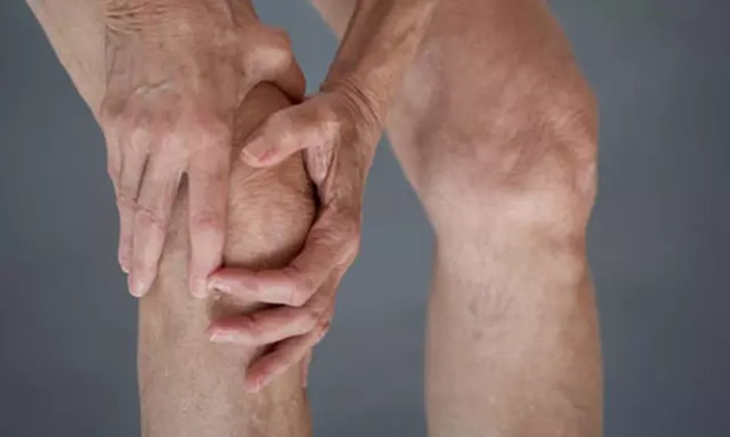 Penyebab Lutut Membengkak, Bukan Cuma Asam Urat