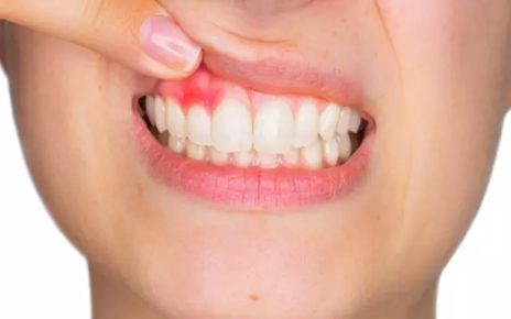 8 Cara Mengobati Gusi Bengkak karena Gigi Berlubang Secara Alami