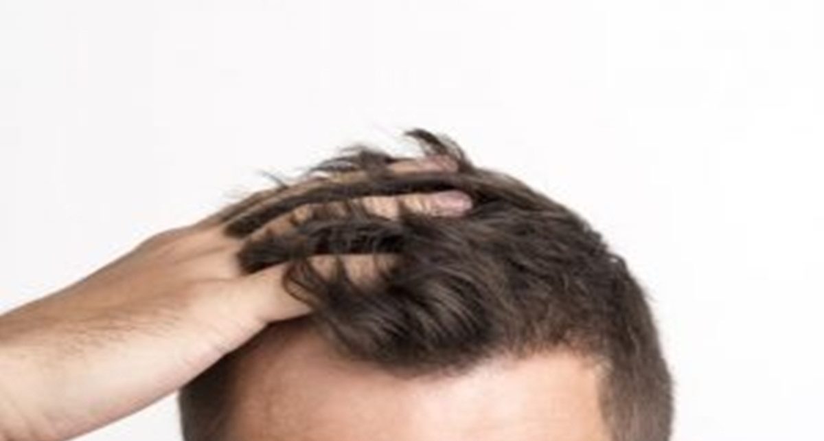 10 Bahan Alami untuk Atasi Kulit Kepala Gatal, Sehatkan Rambut