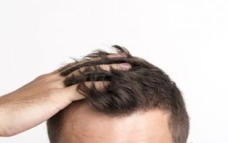 10 Bahan Alami untuk Atasi Kulit Kepala Gatal, Sehatkan Rambut