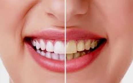 12 Cara Menghilangkan Karang Gigi Membandel, Mudah dan Murah
