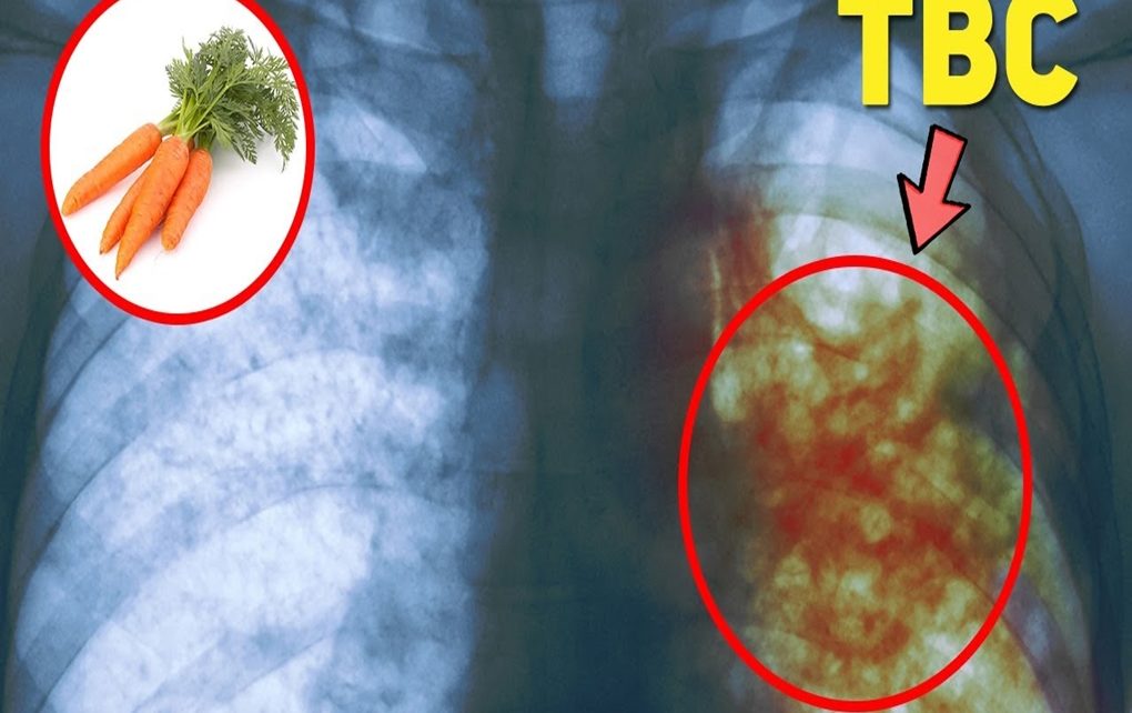 10 Obat Tradisional Penyakit TBC