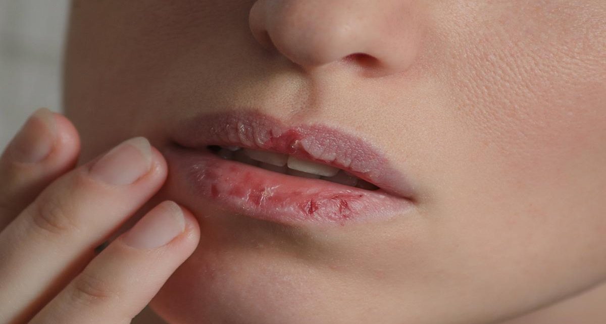 10 Cara Mengatasi Bibir Kering dan Pecah-Pecah yang Aman Dilakukan