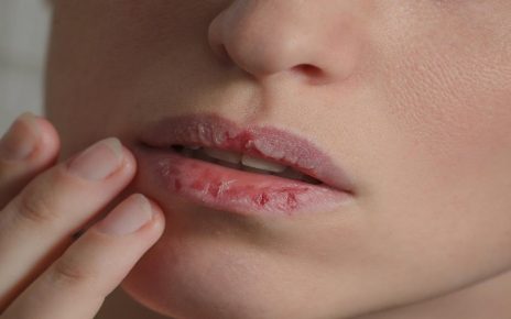 10 Cara Mengatasi Bibir Kering dan Pecah-Pecah yang Aman Dilakukan