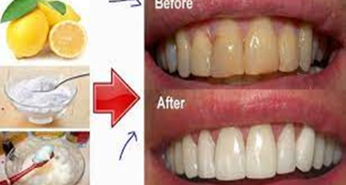 15 Cara Memutihkan Gigi dengan Cepat Secara Alami, Tanpa Efek Samping