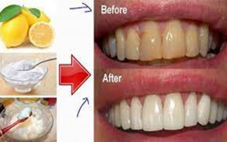 15 Cara Memutihkan Gigi dengan Cepat Secara Alami, Tanpa Efek Samping