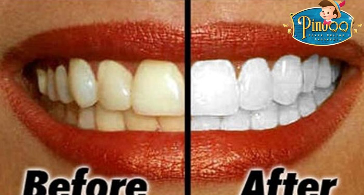 7 Cara Menghilangkan Noda Bekas Kopi di Gigi